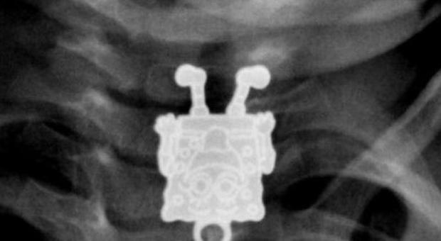 La radiografia con il ciondolo di "SpongeBob" (upi.com)