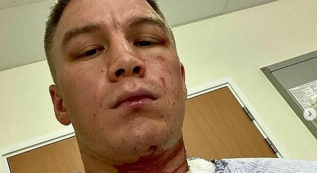 Viktor Kotochigov, l'ex campione di boxe sfregiato con l'acido. Aggredito in casa da uomini incappucciati