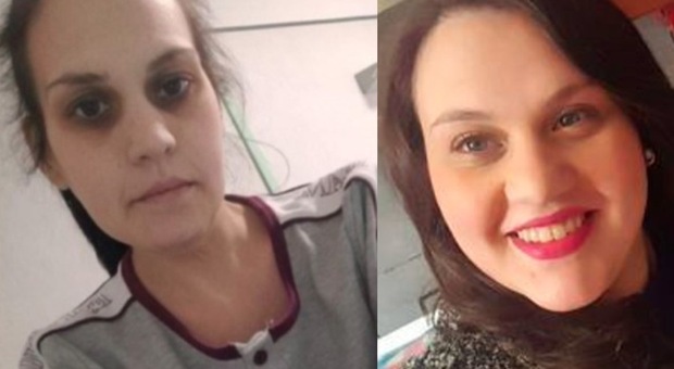 Speranza per Angela Iannotta, la mamma 29enne grave dopo due interventi per dimagire: sarà operata con tecnologia 3D