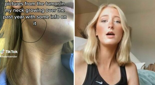 Scopre il tumore sul viso dopo il trattamento di bellezza virale su TikTok: ecco come quel 'brufolo' le ha salvato la vita