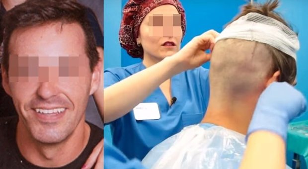 Muore a 39 anni durante il trapianto di capelli: «Infarto dopo l'anestesia»