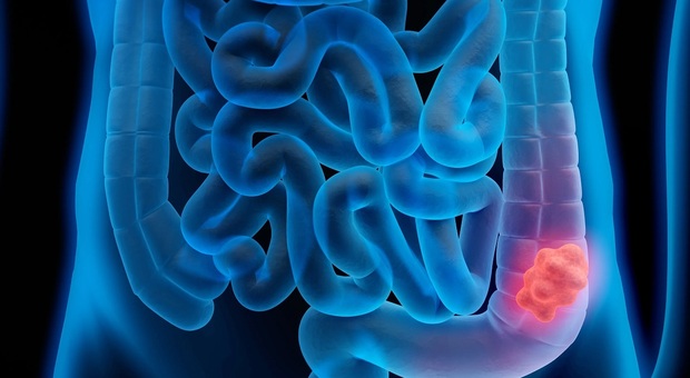 Tumore del colon, ecco i quattro sintomi (tra i giovani) da non sottovalutare: casi in aumento