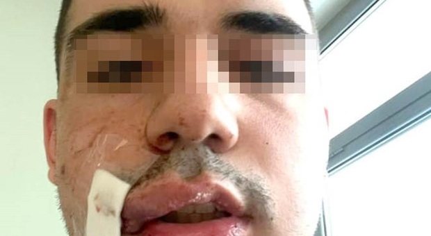 Lanciano, pestaggio durante la movida: ferito il Dj Rokko, 19 anni