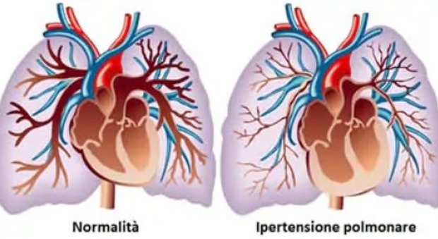 Ipertensione polmonare, esperti a confronto: «Mettiamola alla corde»