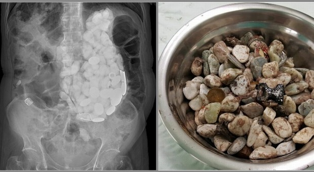 In ospedale per forti dolori, i medici gli trovano nello stomaco 2 kg di tappi, monete e sassi