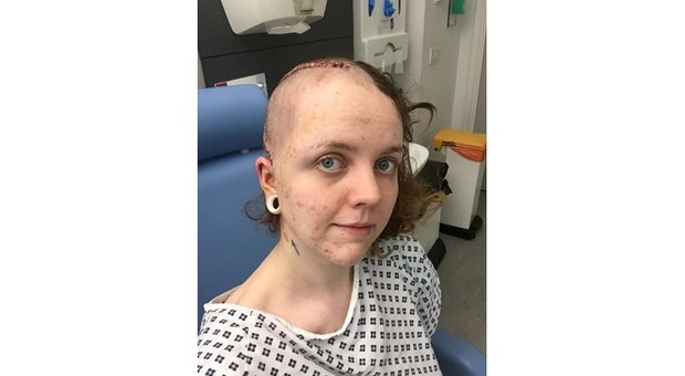 Ragazza colpita da un ictus a soli 22 anni: «Non dovevo sottovalutare i segnali della malattia»