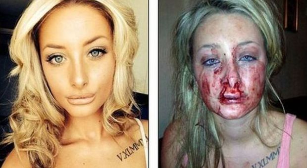 "Sei troppo bella, sono geloso": il fidanzato furioso per una foto su Fb, la bacia e le stacca il labbro