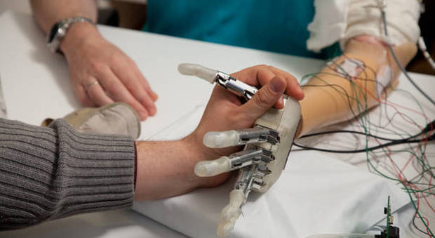 Mano bionica impiantata in una donna italiana: è la prima volta