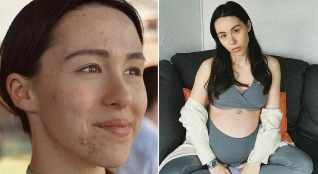 Aurora Ramazzotti, la battaglia contro l'acne: sui social le foto prima e dopo il percorso di cura (durato tre anni)