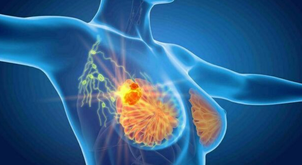 Tumore al seno, scoperta proteina che potrebbe prevenirlo: “uccide” le cellule malate