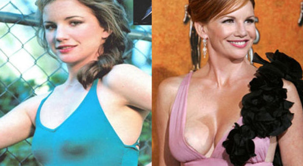 Melissa Gilbert prima e dopo gli interventi al seno (plasticsurgeryid.com)
