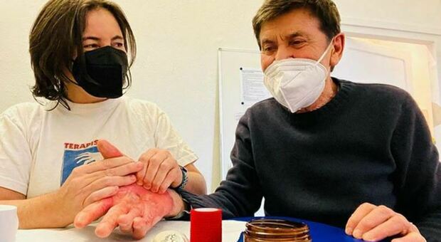 Dieci mesi fa la grande paura: Gianni Morandi mostra per la prima volta la gravità dell’ustione subita alla mano