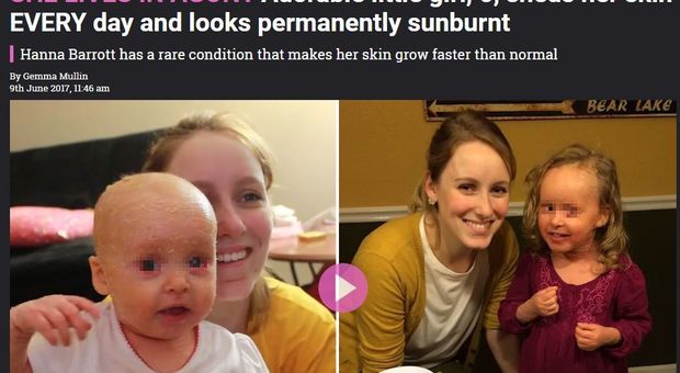 Bimba di 6 anni affetta da una rara malattia genetica: "Il suo organismo produce troppa pelle"