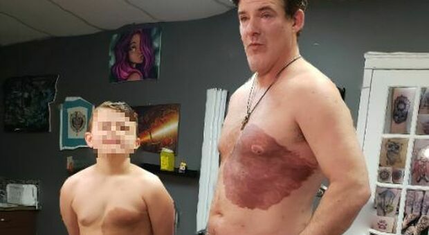 Il figlio si vergogna di una grande voglia sul torso, il padre si sottopone a 30 ore di tatuaggio per non farlo sentire diverso