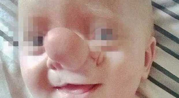 Ollie, il bambino soprannominato Pinocchio: il cervello gli cresce dentro  il naso -Foto