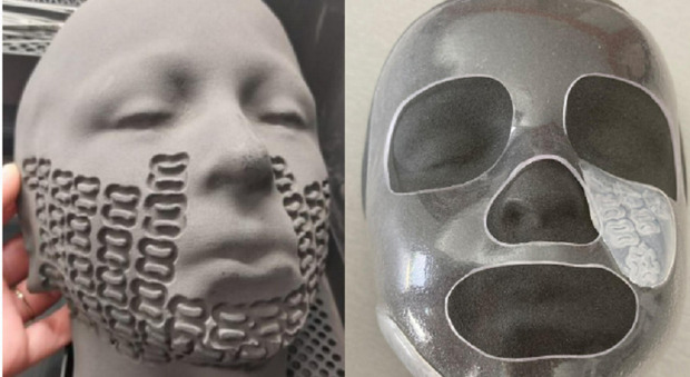 Stampa in 3D del volto dei bambini ustionati per cure migliori e meno dolorose