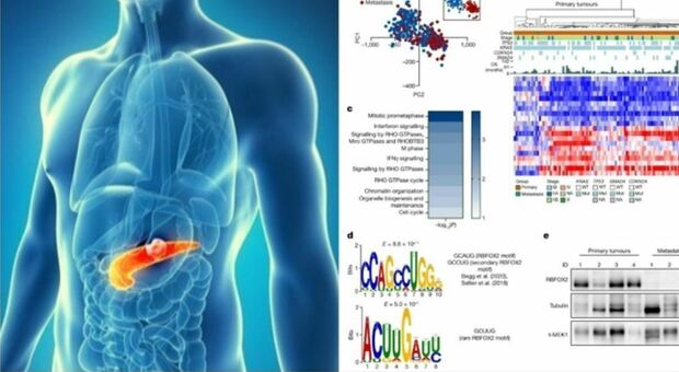 Tumore al pancreas, la combinazione di due farmaci potrebbe potenziare la chemioterapia: lo studio