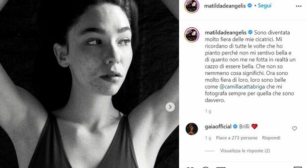 Matilda De Angelis torna a mostrare l'acne: «Fiera delle mie cicatrici, non mi importa di essere bella»