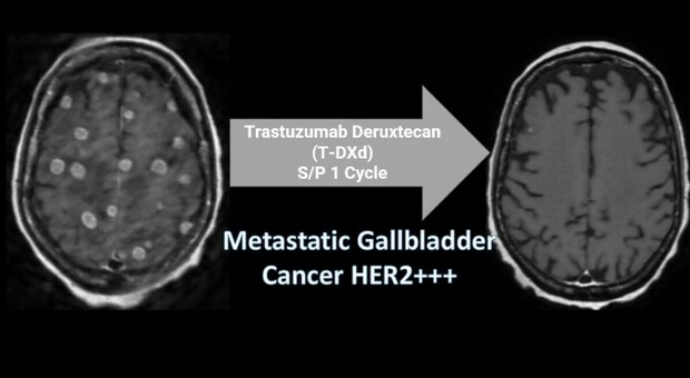 Tumore al seno, cos'è (e come funziona) l'anticorpo Trastuzumab: metastasi al cervello scomparsa dopo un solo trattamento