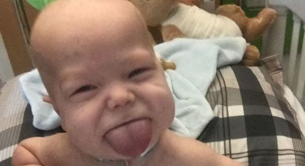La lingua del bimbo non smette di crescere, i medici ne asportano la metà per farlo sorridere