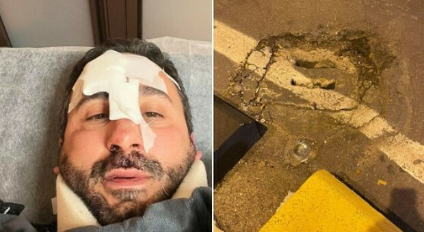 Lo chef Natale Giunta cade in una buca con il monopattino a Palermo: «Naso rotto e traumi ovunque»