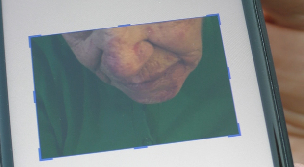 Anziana rapinata e picchiata in casa. Radiografia choc: «Una lama del coltello rimasta conficcata nel collo»