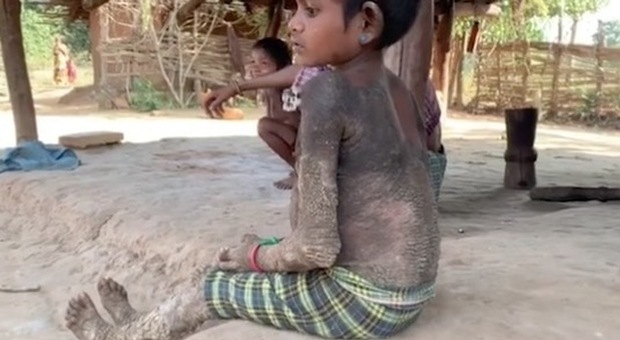 Bambina di 7 anni si sta "pietrificando" per l'ittiosi: «Doloroso sedersi e camminare»