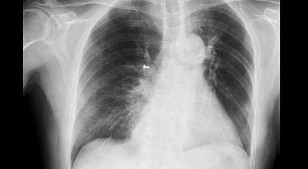 La radiografia del paziente con la vite accanto al polmone di sinistra