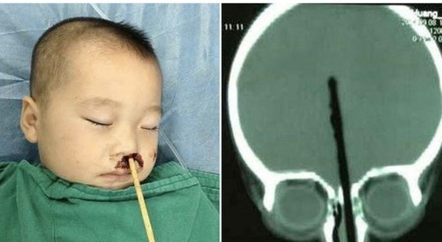 Bimbo di 2 anni si infila una bacchetta nel naso: i medici la rimuovono dal cervello e lo salvano