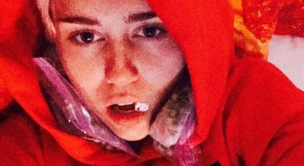 Miley Cyrus disgustosa: si fa togliere i denti del giudizio e li posta sul socialnetwork