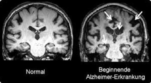 Giornata Alzheimer, a Roma test preventivi gratis