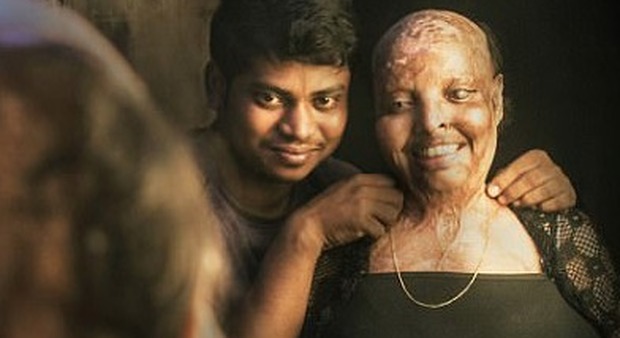 India, sfigurata con l'acido da un pretendente rifiutato: dieci anni dopo trova l'amore in ospedale