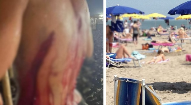Aggressione choc a Rosolina mare: 16enne accoltellato da una banda in spiaggia. Ferite da 7 centimetri