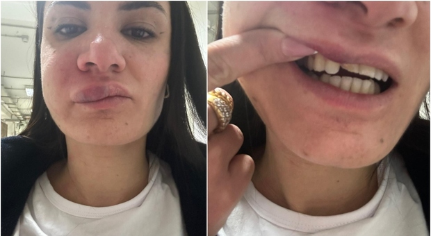 Anna Procida, chi è l'infermiera aggredita a Castellammare: «Sono un mostro, ho le labbra gonfie»