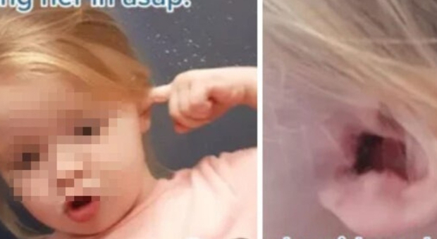 Bimba di 2 anni ha orecchio arrossato e prurito, scoperta choc dal pediatra