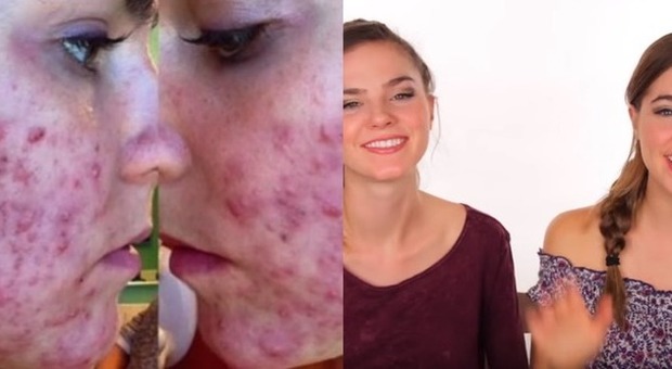 "Abbiamo sconfitto l'acne in soli 3 giorni" Le gemelline 22enni mostrano come