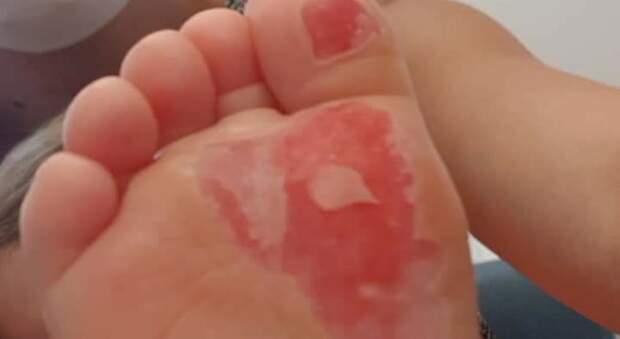 Un episodio scioccante in Inghilterra: i piedi di un bambino bruciati dal calore delle piastrelle