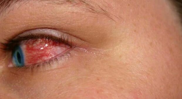 Febbre emorragica occhi, un caso in Europa: «Virus mortale in un caso su tre»