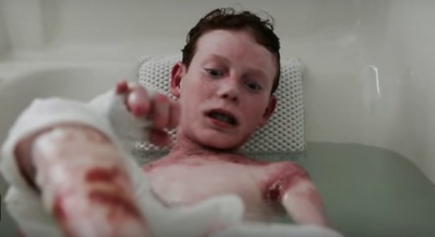 Il bambino farfalla, Jonathan Pitre, non ce l'ha fatta: morto all'eta di 17 anni (Youtube)