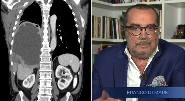 Mesotelioma, cos'è il tumore raro (legato all'amianto) di cui soffriva Franco Di Mare: i sintomi e le cure