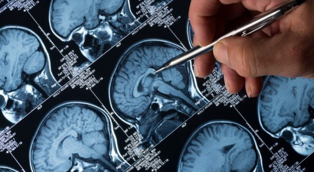 Alzheimer, uno studio rivela un campanello d'allarme bizzarro: ecco di cosa si tratta