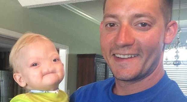 Bimbo nato senza naso muore a 2 anni, la storia del piccolo Eli aveva commosso il mondo