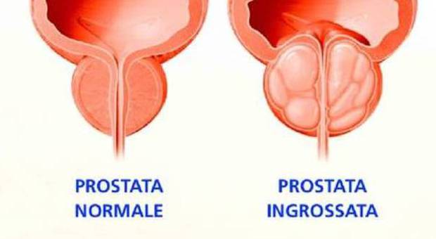 Prostata, problemi per 7 milioni di italiani. Ma la metà li ignora. Il test