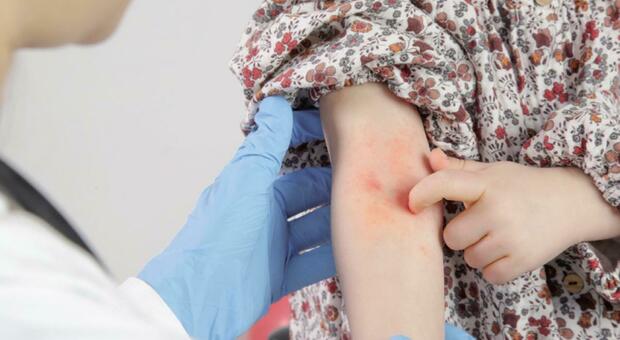Dermatite atopica, i falsi miti