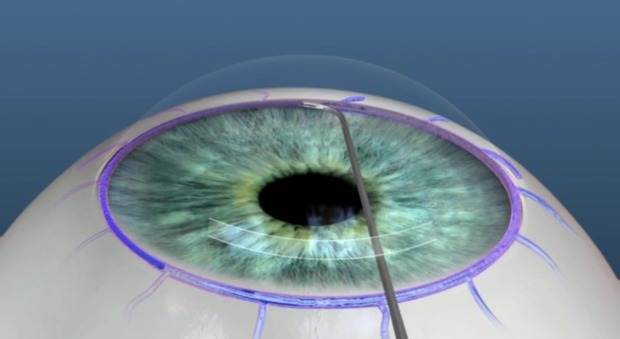 Glaucoma, tre pazienti operati e guariti con la canaloplastica