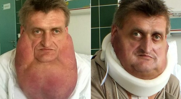 Stefan Zoleik, prima e dopo l'operazione
