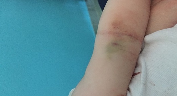 Sofia, due mesi: rischia di morire perché in ospedale manca un ago