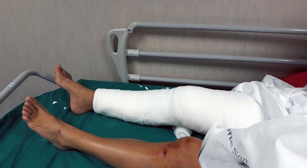 Roma, investita da due rom: la donna ha più fratture alla gamba
