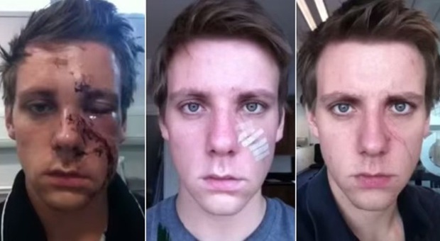Aggredito e sfigurato in volto, il video ​in time-lapse fino alla guarigione