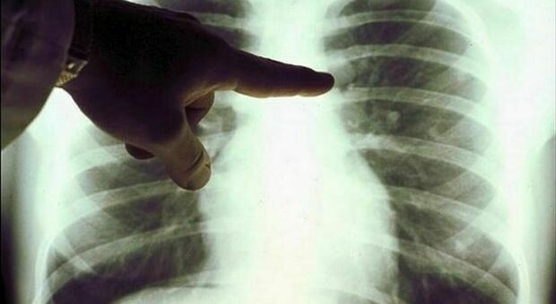 Tumore ai polmoni, ora rimborsabile un farmaco che può bloccare la malattia anche per diversi anni